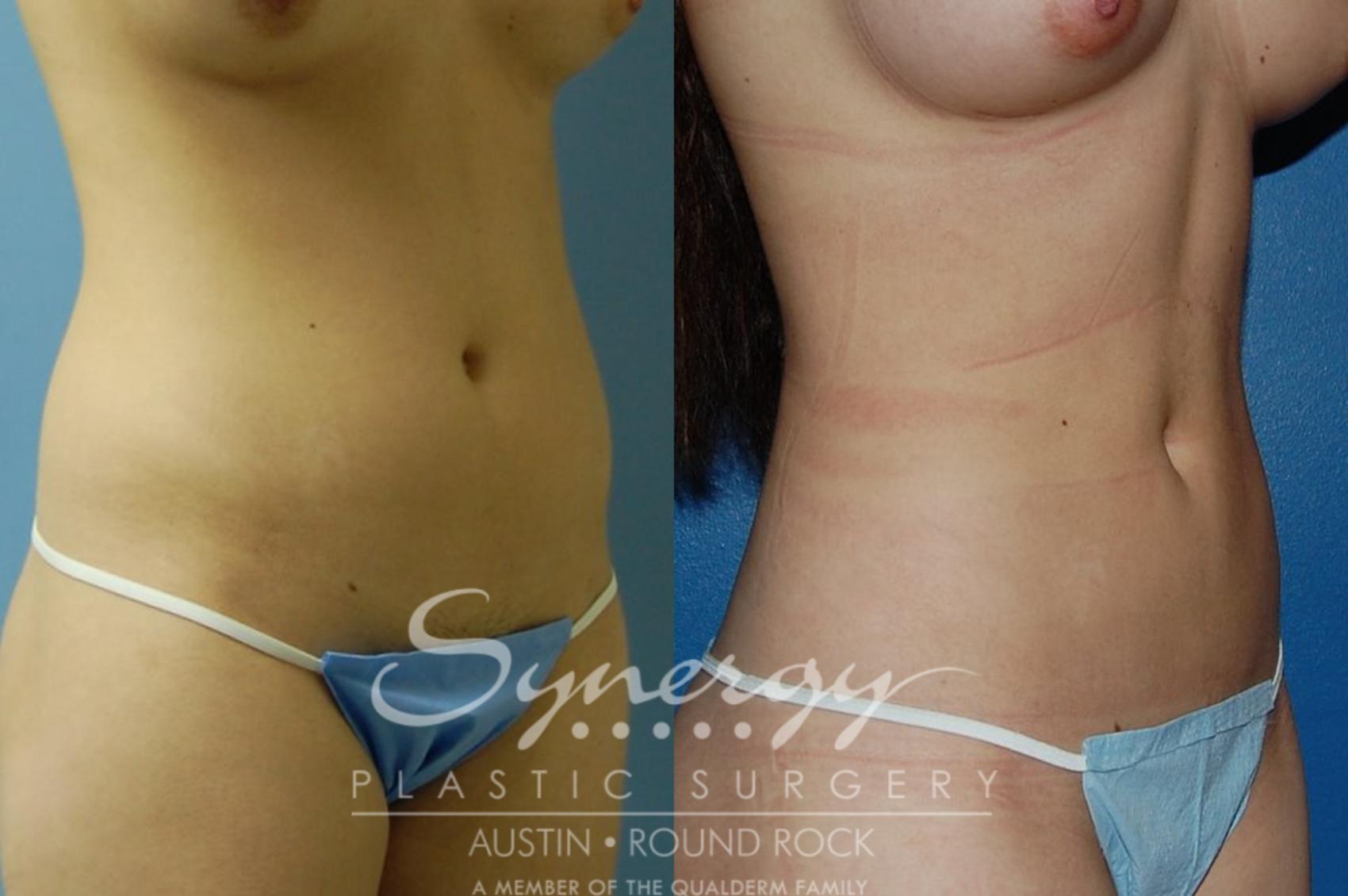 Before & After Liposuction Case 29 View #1 View in Austin, TX