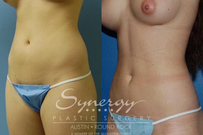 Before & After Liposuction Case 29 View #2 View in Round Rock, TX