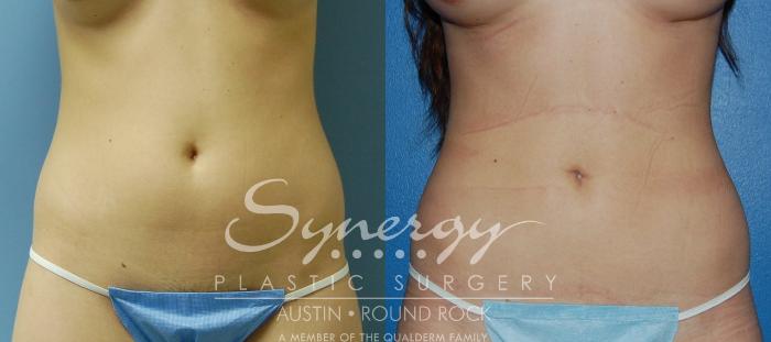 Before & After Liposuction Case 29 View #3 View in Round Rock, TX