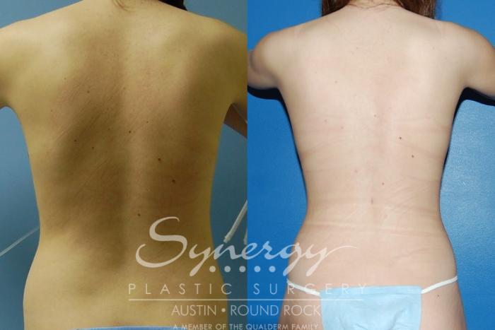 Before & After Liposuction Case 29 View #4 View in Round Rock, TX