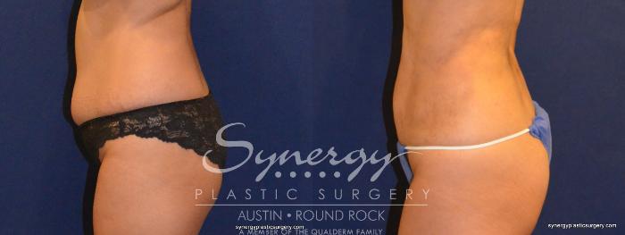 Before & After Liposuction Case 323 View #2 View in Austin, TX