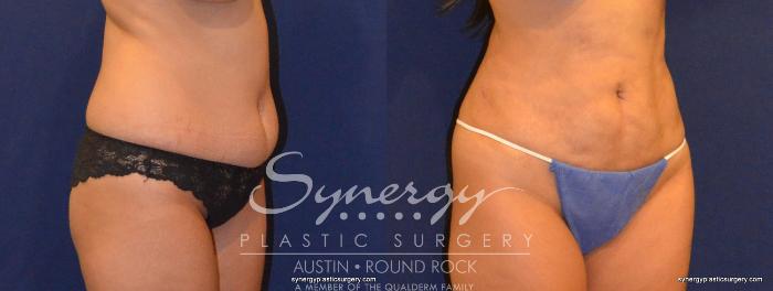 Before & After Liposuction Case 323 View #3 View in Austin, TX
