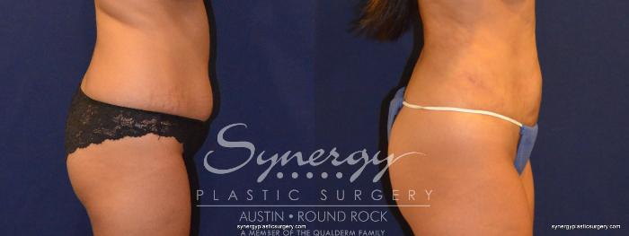 Before & After Liposuction Case 323 View #4 View in Austin, TX