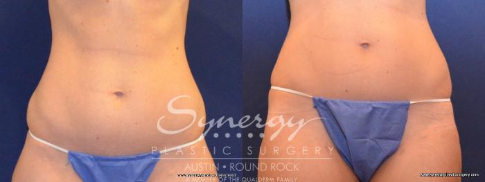 Before & After Liposuction Case 432 View #1 View in Round Rock, TX