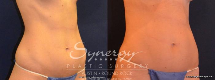 Before & After Liposuction Case 432 View #2 View in Austin, TX