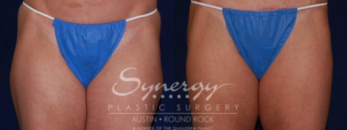 Before & After Liposuction Case 49 View #1 View in Austin, TX