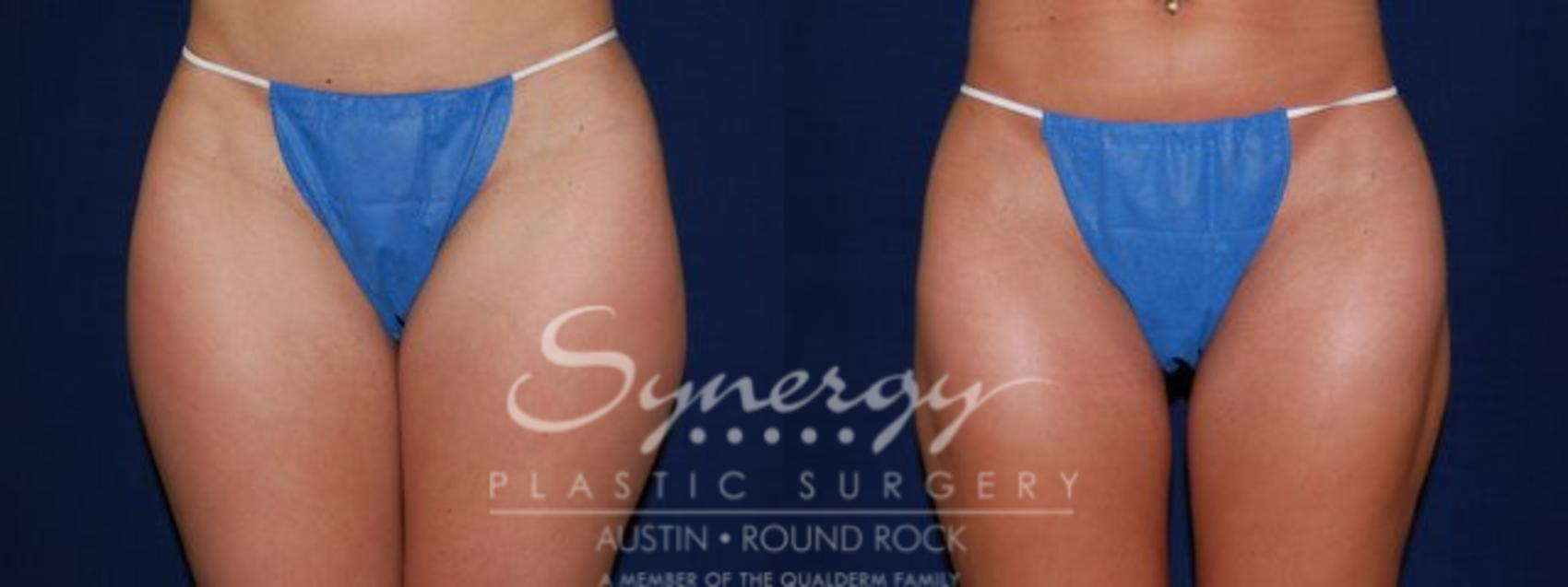 Before & After Liposuction Case 52 View #1 View in Round Rock, TX