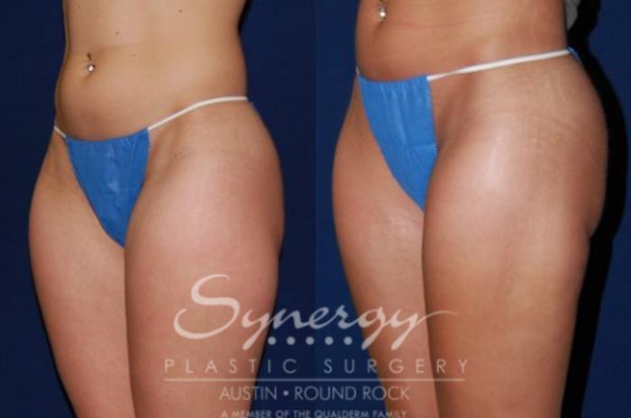 Before & After Liposuction Case 52 View #2 View in Austin, TX