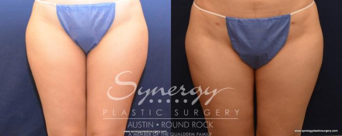 Before & After Liposuction Case 530 View #2 View in Austin, TX