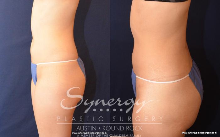 Before & After Liposuction Case 530 View #3 View in Austin, TX