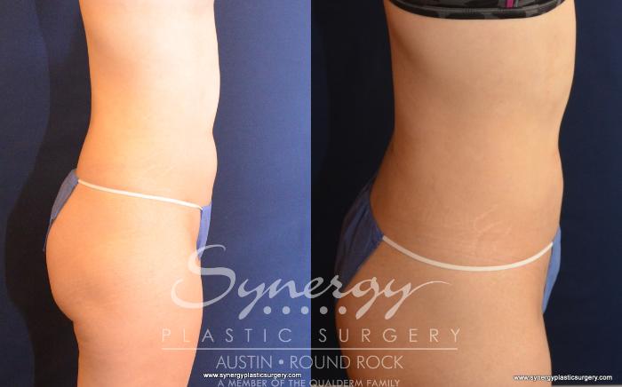 Before & After Liposuction Case 530 View #4 View in Austin, TX