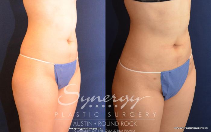 Before & After Liposuction Case 530 View #5 View in Austin, TX