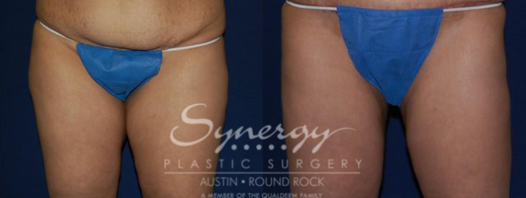 Before & After Liposuction Case 60 View #1 View in Round Rock, TX