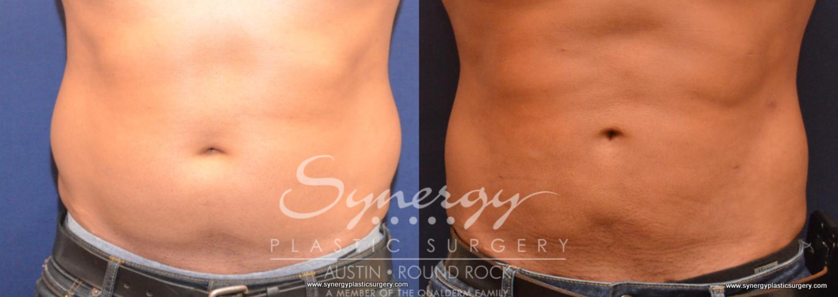 Before & After Liposuction Case 713 View #1 View in Round Rock, TX