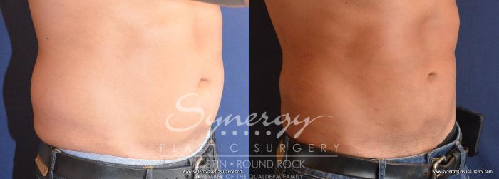 Before & After Liposuction Case 713 View #2 View in Austin, TX