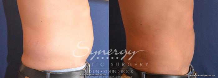 Before & After Liposuction Case 713 View #3 View in Austin, TX