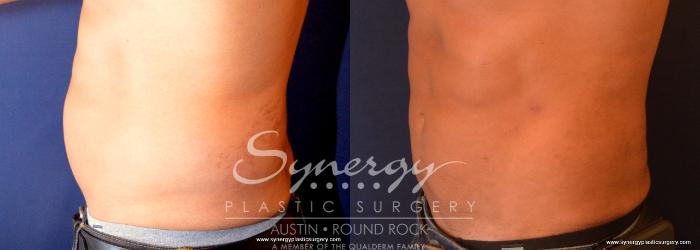 Before & After Liposuction Case 713 View #4 View in Austin, TX