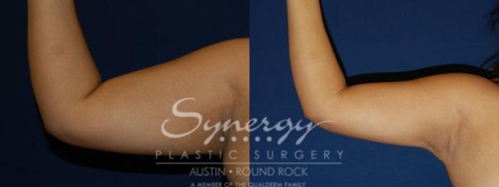 Before & After Liposuction Case 76 View #2 View in Round Rock, TX