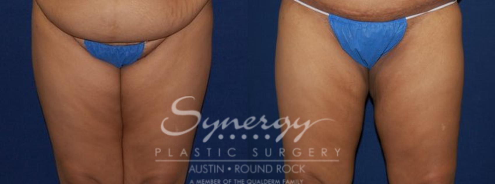 Before & After Liposuction Case 77 View #1 View in Round Rock, TX