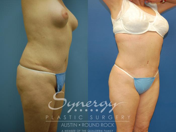 Before & After Liposuction Case 8 View #2 View in Austin, TX