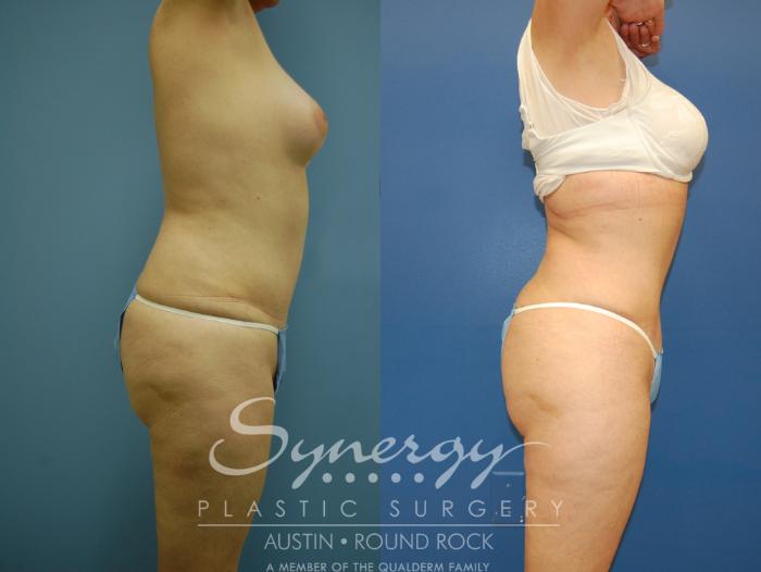 Before & After Liposuction Case 8 View #4 View in Austin, TX