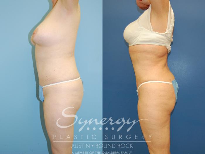 Before & After Liposuction Case 8 View #5 View in Austin, TX