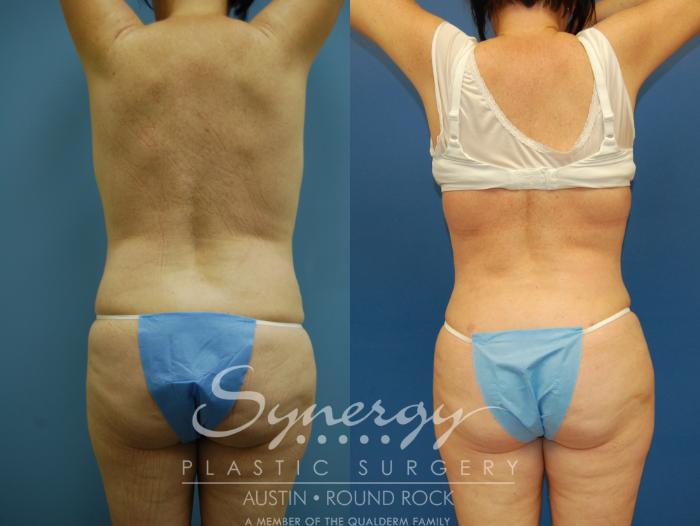 Before & After Liposuction Case 8 View #6 View in Austin, TX