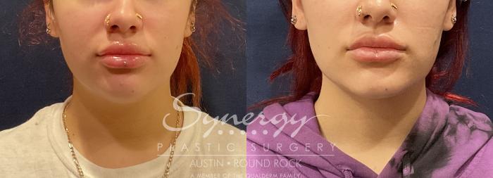 Before & After Liposuction Case 811 Front View in Austin, TX