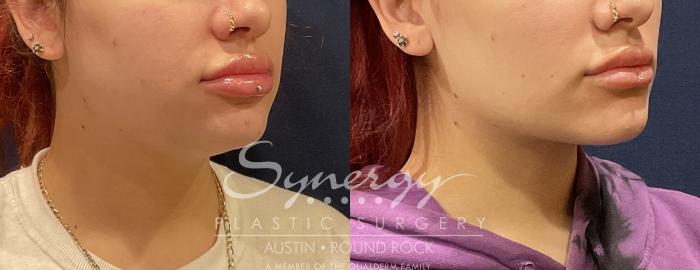Before & After Liposuction Case 811 Left Oblique View in Austin, TX