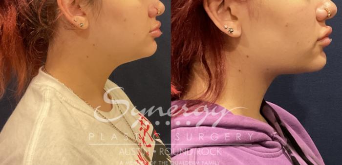 Before & After Liposuction Case 811 Left Side View in Austin, TX