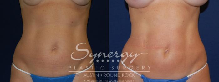 Before & After Liposuction Case 84 View #1 View in Round Rock, TX