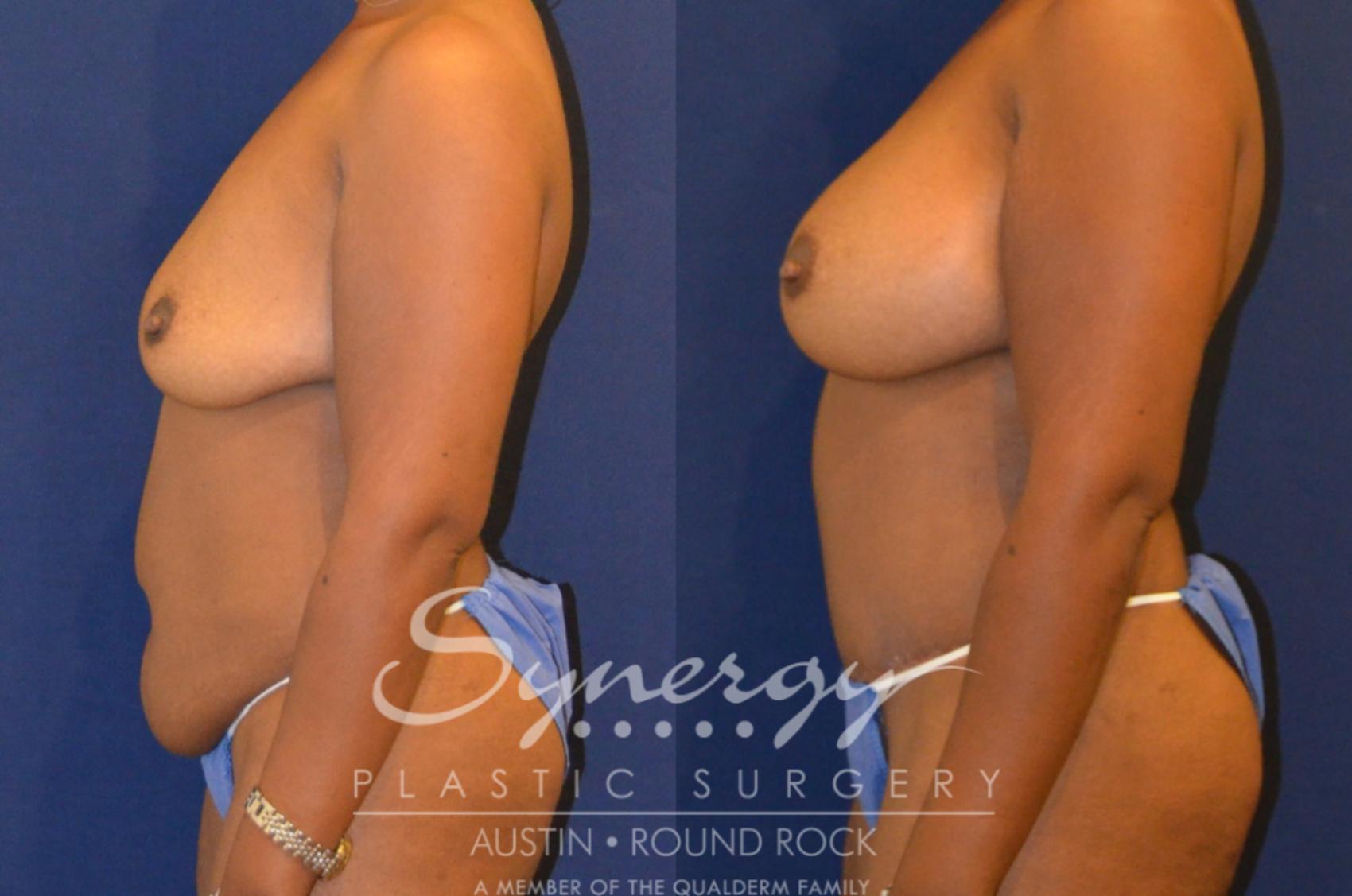Before & After Mommy Makeover Case 297 View #4 View in Round Rock, TX