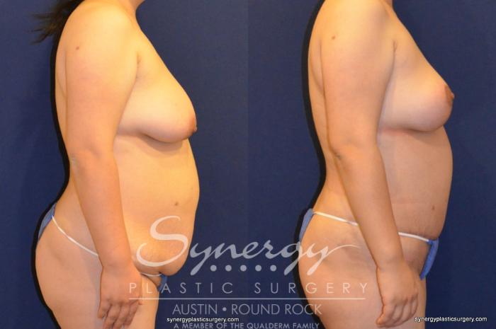 Before & After Mommy Makeover Case 395 View #2 View in Austin, TX