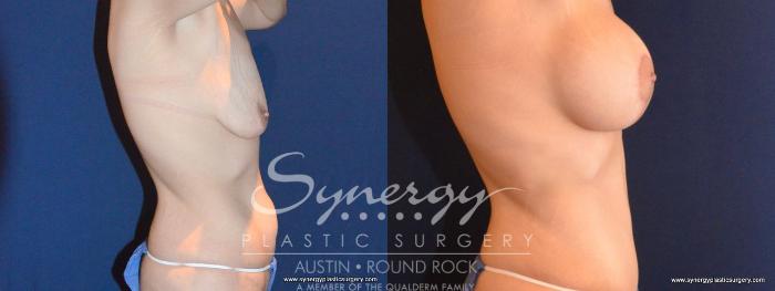 Before & After Mommy Makeover Case 456 View #4 View in Austin, TX