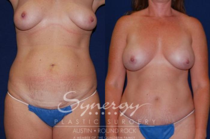 Before & After Mommy Makeover Case 54 View #3 View in Austin, TX
