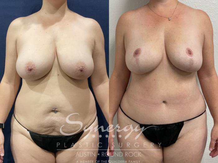 Before & After Breast Reduction Case 882 Front View in Austin, TX