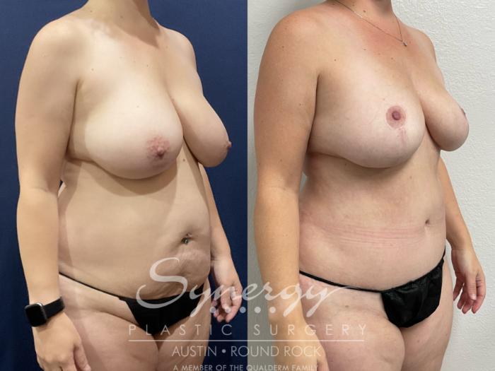 Before & After Abdominoplasty (Tummy Tuck) Case 882 Left Oblique View in Austin, TX