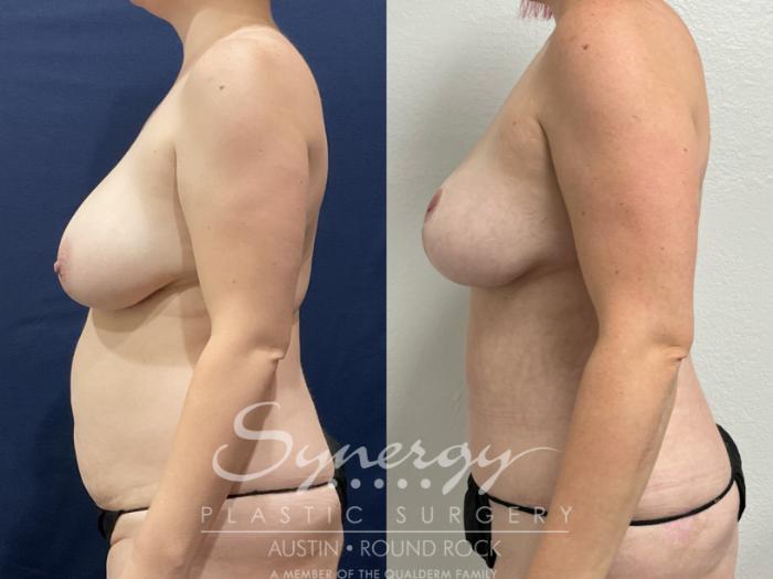 Before & After Breast Lift (Mastopexy) Case 882 Right Side View in Austin, TX