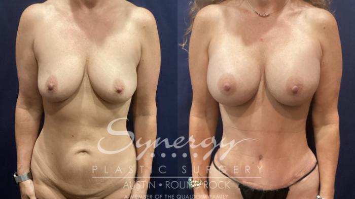 Before & After Abdominoplasty (Tummy Tuck) Case 905 Front View in Austin, TX