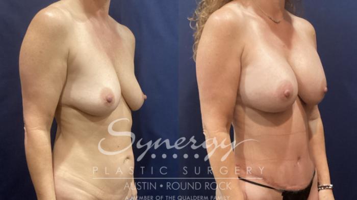 Before & After Abdominoplasty (Tummy Tuck) Case 905 Right Oblique View in Austin, TX