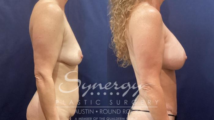 Before & After Mommy Makeover Case 905 Right Side View in Austin, TX