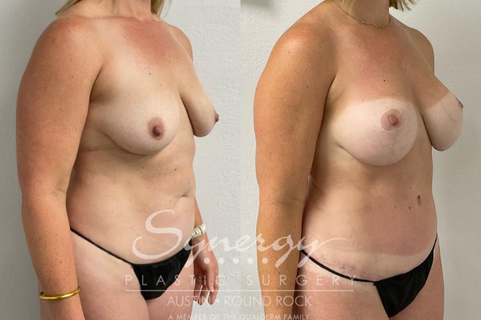 Before & After Mommy Makeover Case 912 Right Oblique View in Austin, TX