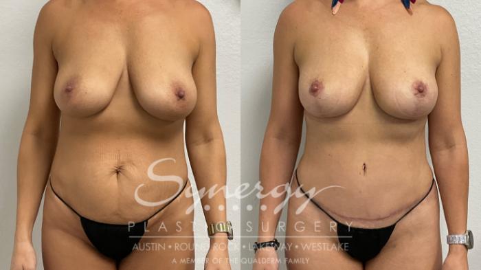 Breast Lift Before & After Photos | 48-Year-Old Patient | Synergy Plastic Surgery Austin