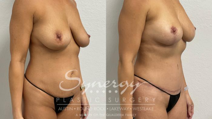 Breast Lift Before & After Photos | 48-Year-Old Patient | Synergy Plastic Surgery Austin