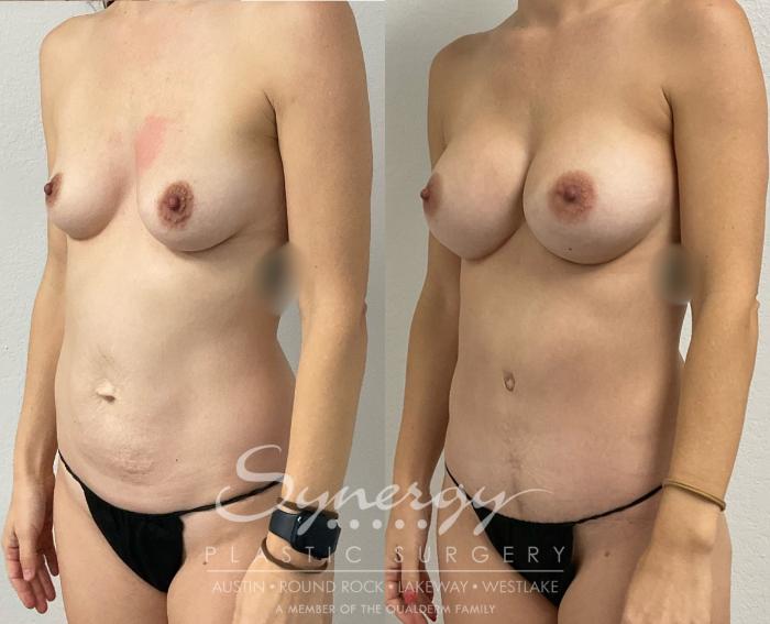 Before & After Breast Augmentation Case 957 Left Oblique View in Austin, TX