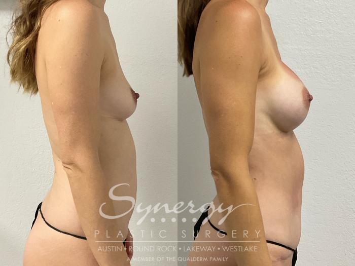 Abdominoplasty, tummy tuck, abdominal contouring, excess skin removal, muscle tightening, flat abdomen.  Breast augmentation, bilateral breast augmentation, silicone implants, Allergan SoftTouch, smooth round implants, full profile implants, 345cc implant, 385cc implant.  Liposuction, bilateral hip liposuction, hip contouring, fat removal, body sculpting.  Umbilical hernia repair, suture repair, abdominal wall repair, hernia correction.