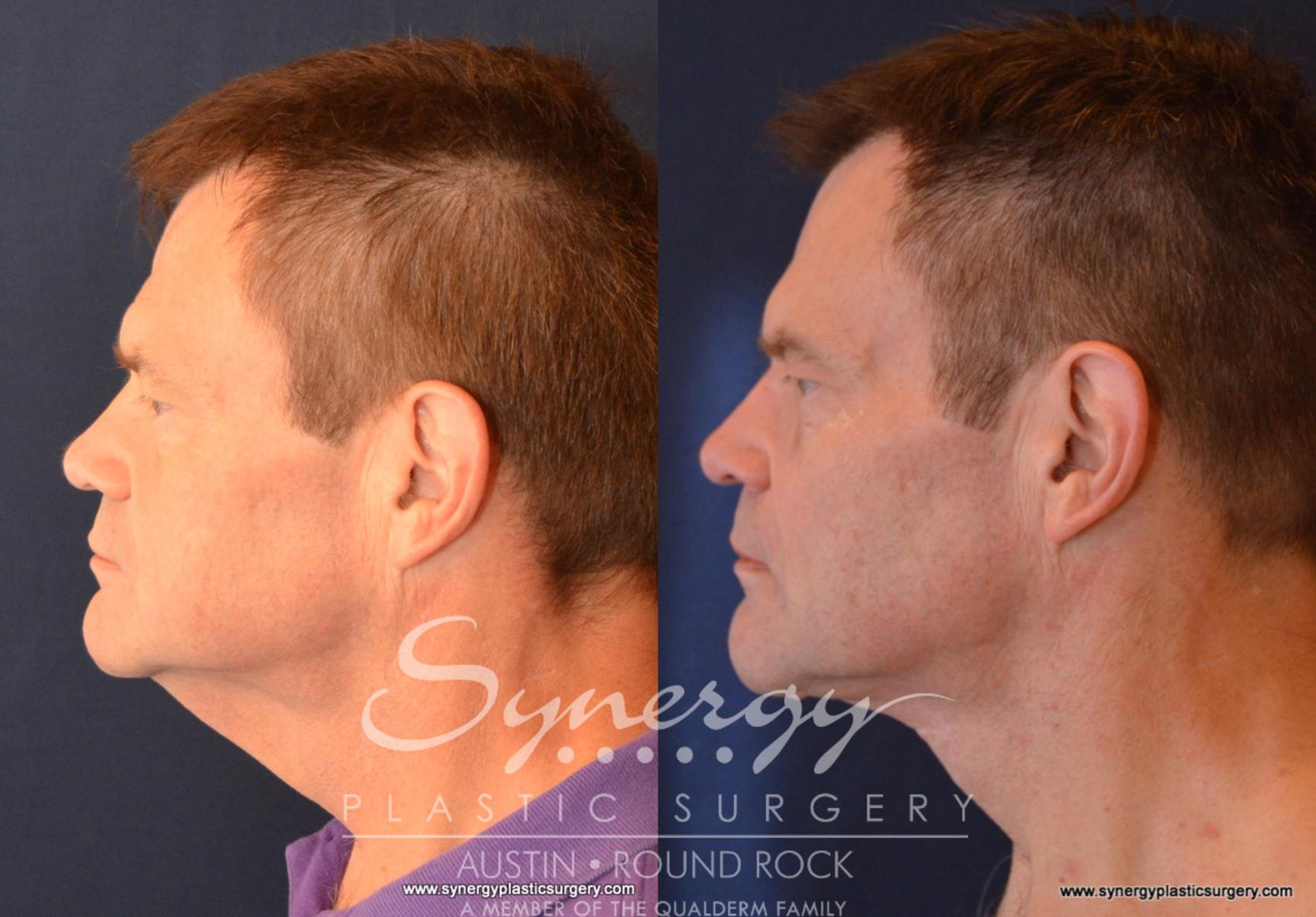 Before & After Neck Lift (Cervicoplasty) Case 601 View #1 View in Round Rock, TX