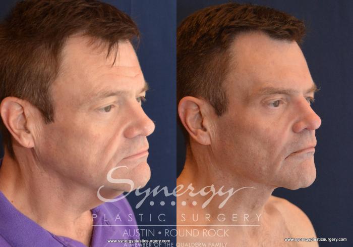 Before & After Neck Lift (Cervicoplasty) Case 601 View #2 View in Austin, TX