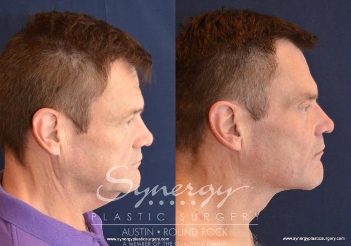 Before & After Neck Lift (Cervicoplasty) Case 601 View #3 View in Austin, TX