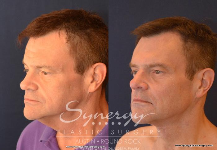 Before & After Neck Lift (Cervicoplasty) Case 601 View #4 View in Austin, TX